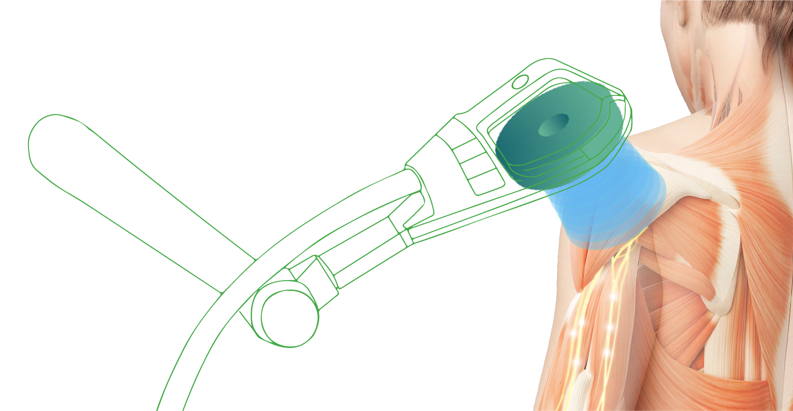 Высокоинтенсивная магнитотерапия эффект